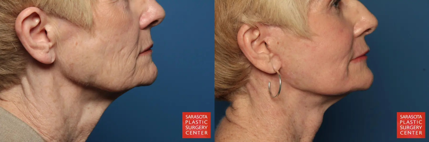 Laser Skin Resurfacing - Face: Patient 15 - Before and After 5