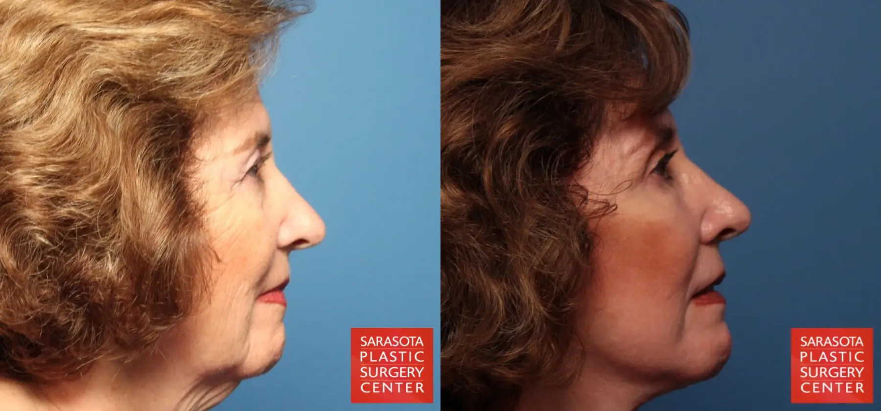 Laser Skin Resurfacing - Face: Patient 6 - Before and After 3