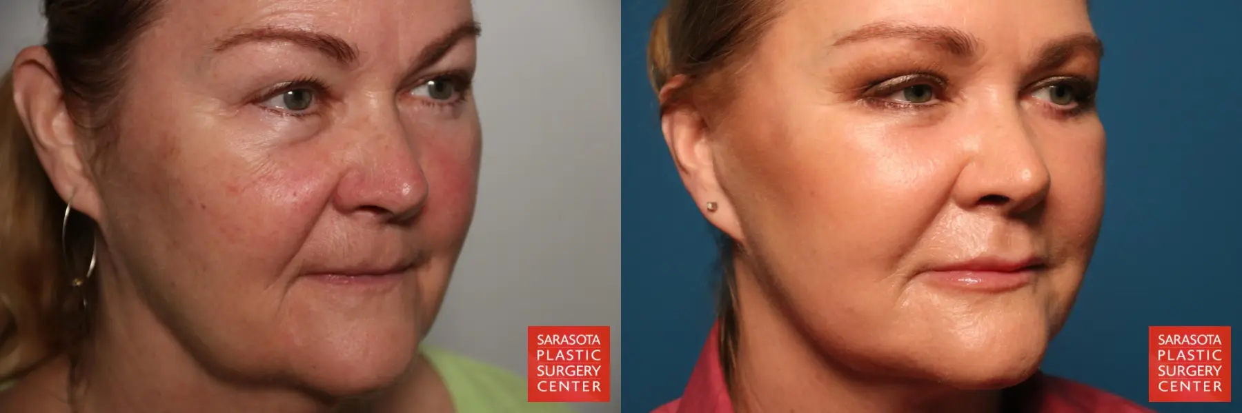 Laser Skin Resurfacing - Face: Patient 17 - Before and After 3