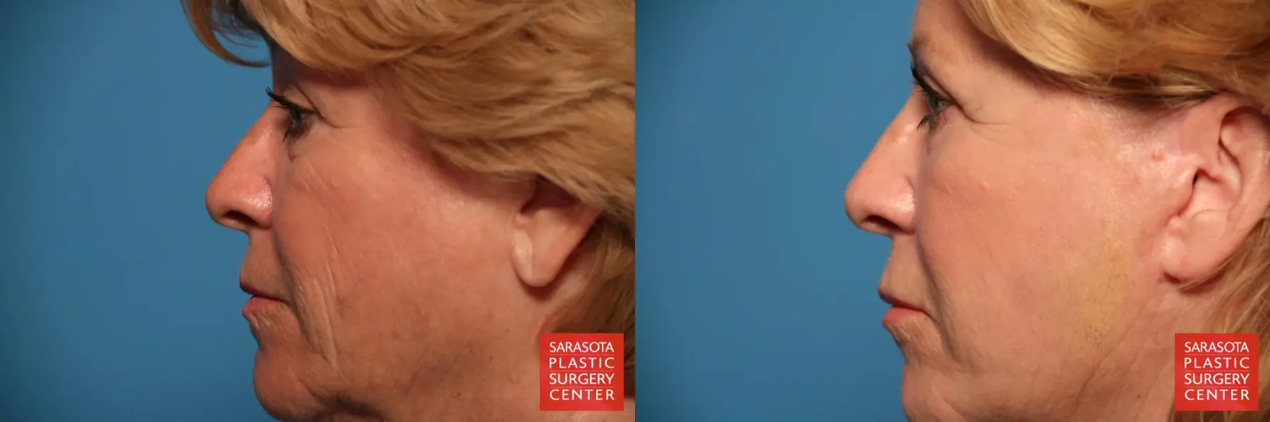 Laser Skin Resurfacing - Face: Patient 10 - Before and After 3
