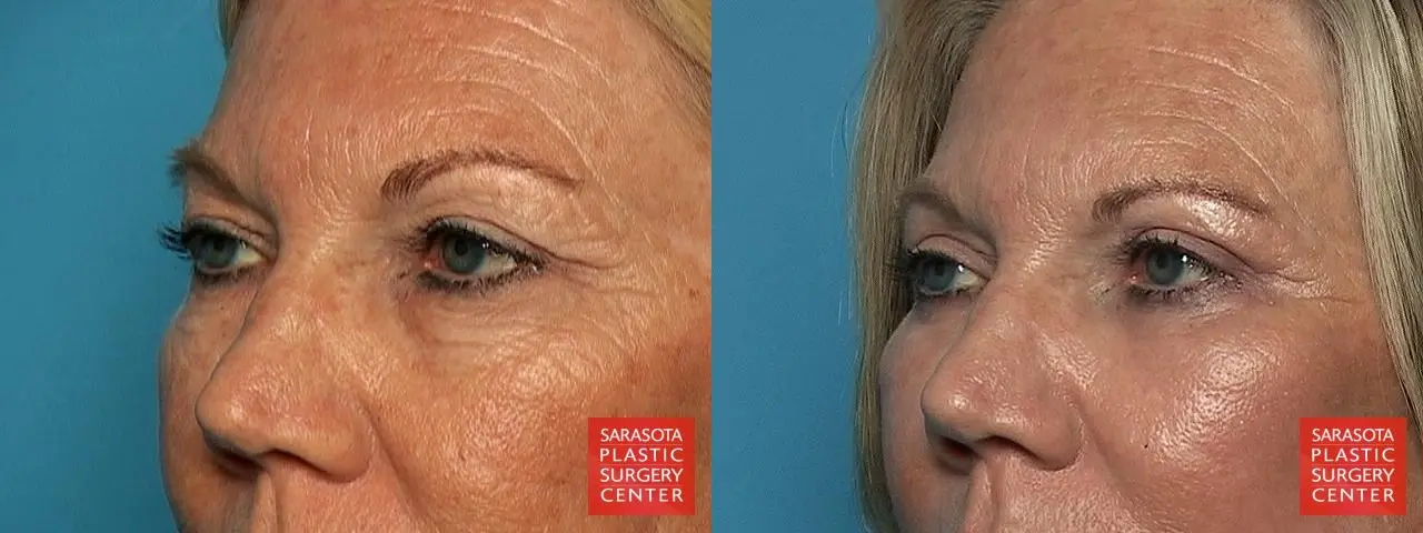 Laser Skin Resurfacing - Face: Patient 2 - Before and After 2
