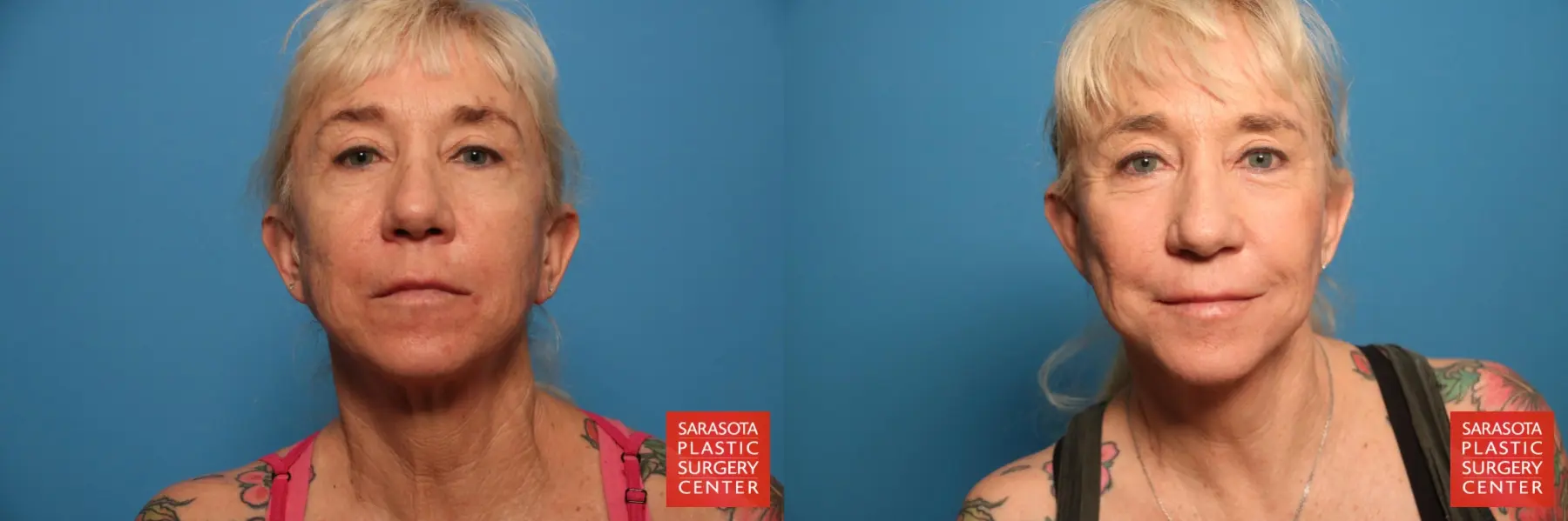 Laser Skin Resurfacing - Face: Patient 18 - Before and After 1