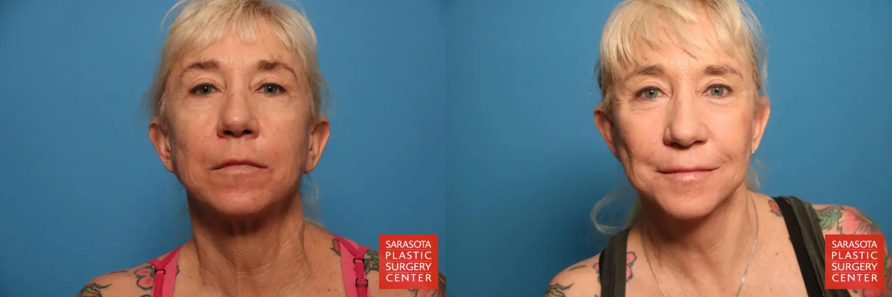 Laser Skin Resurfacing - Face: Patient 18 - Before and After  