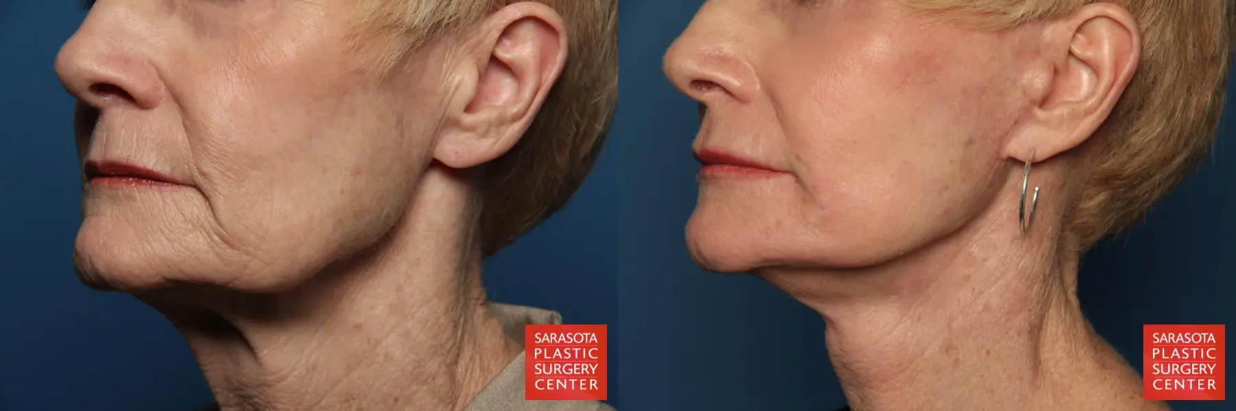 Laser Skin Resurfacing - Face: Patient 15 - Before and After 2
