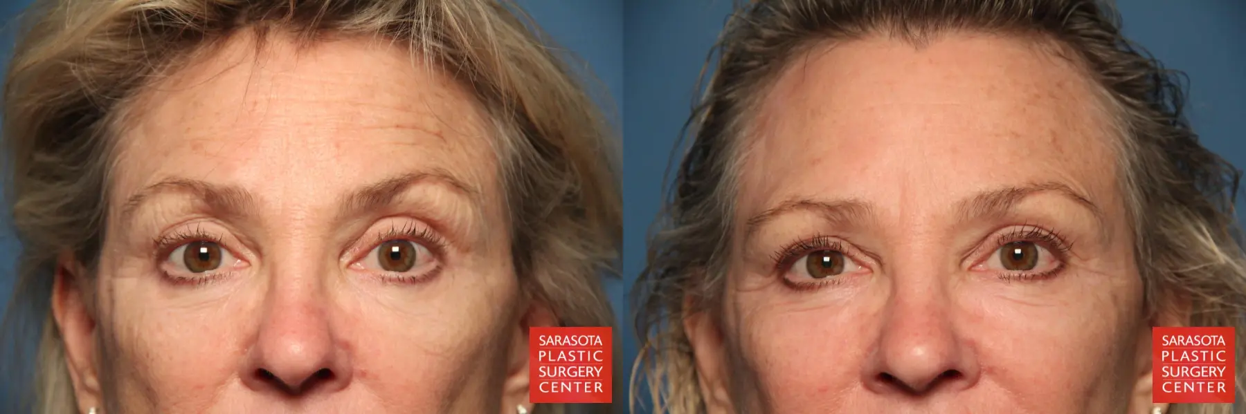 Laser Skin Resurfacing - Face: Patient 9 - Before and After 4
