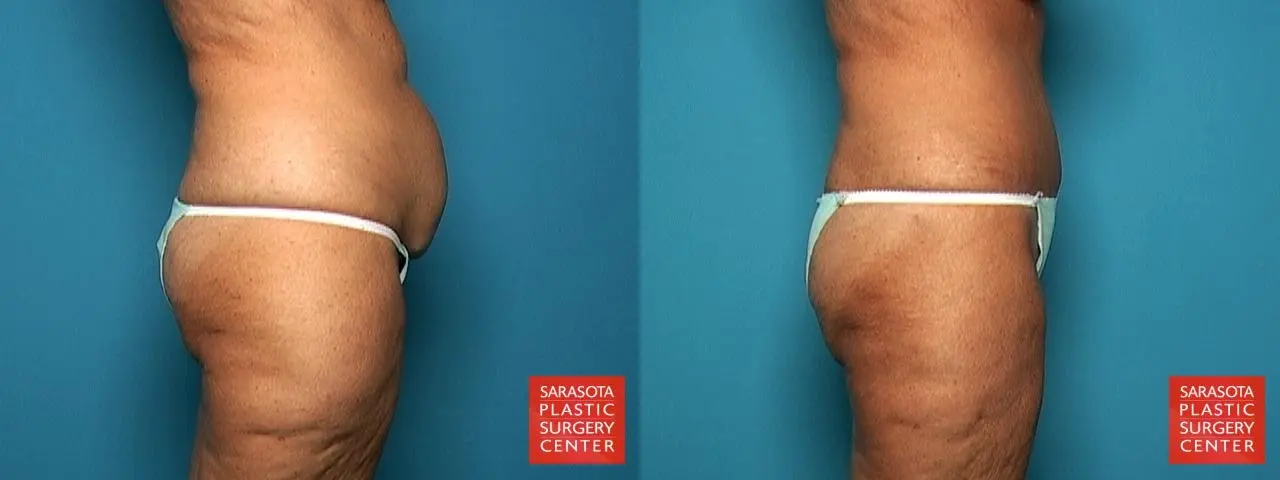 Liposuction: Patient 9 - Before and After 7