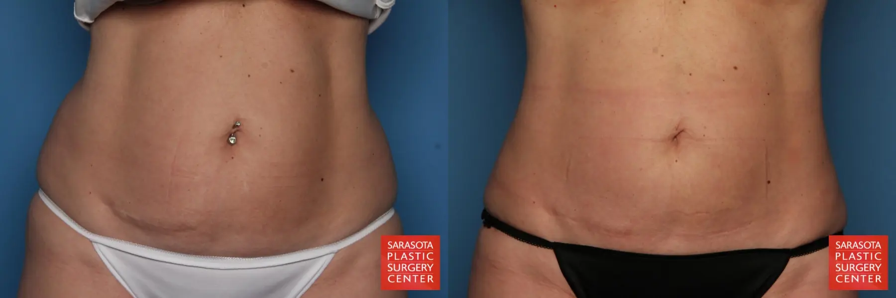 Liposuction: Patient 8 - Before and After  