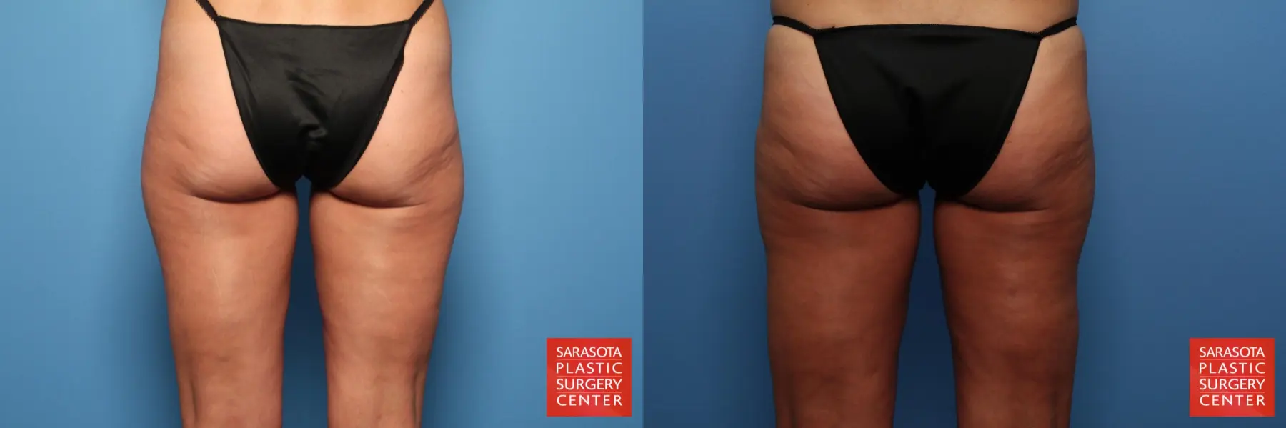 Liposuction: Patient 9 - Before and After 5