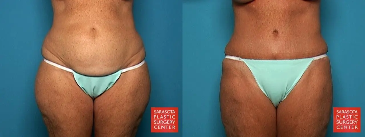 Liposuction: Patient 9 - Before and After  