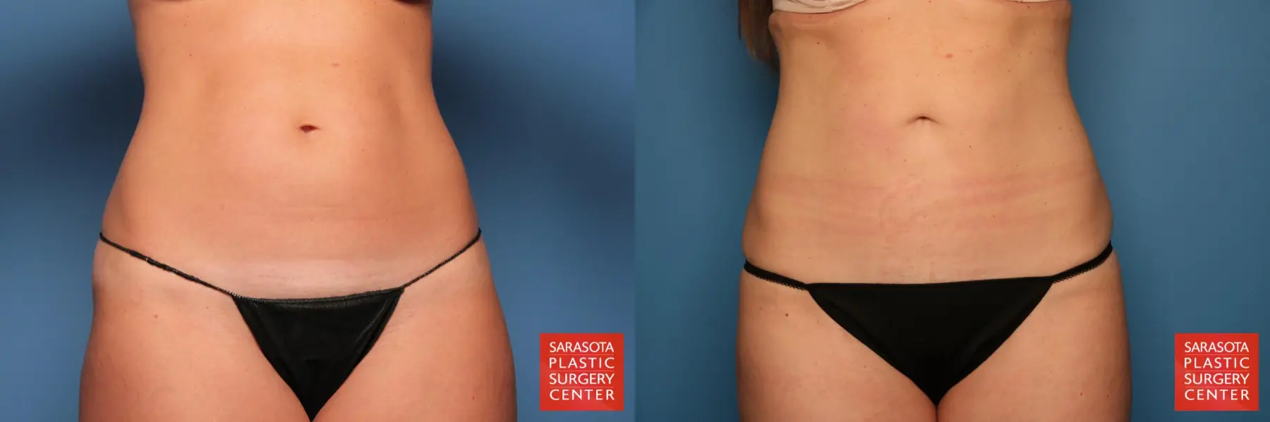 Liposuction: Patient 12 - Before and After  