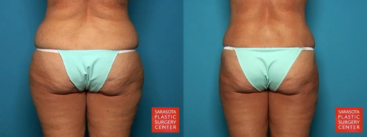 Liposuction: Patient 9 - Before and After 2