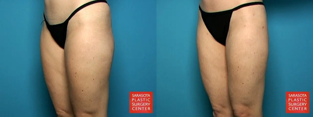 Liposuction: Patient 1 - Before and After 2
