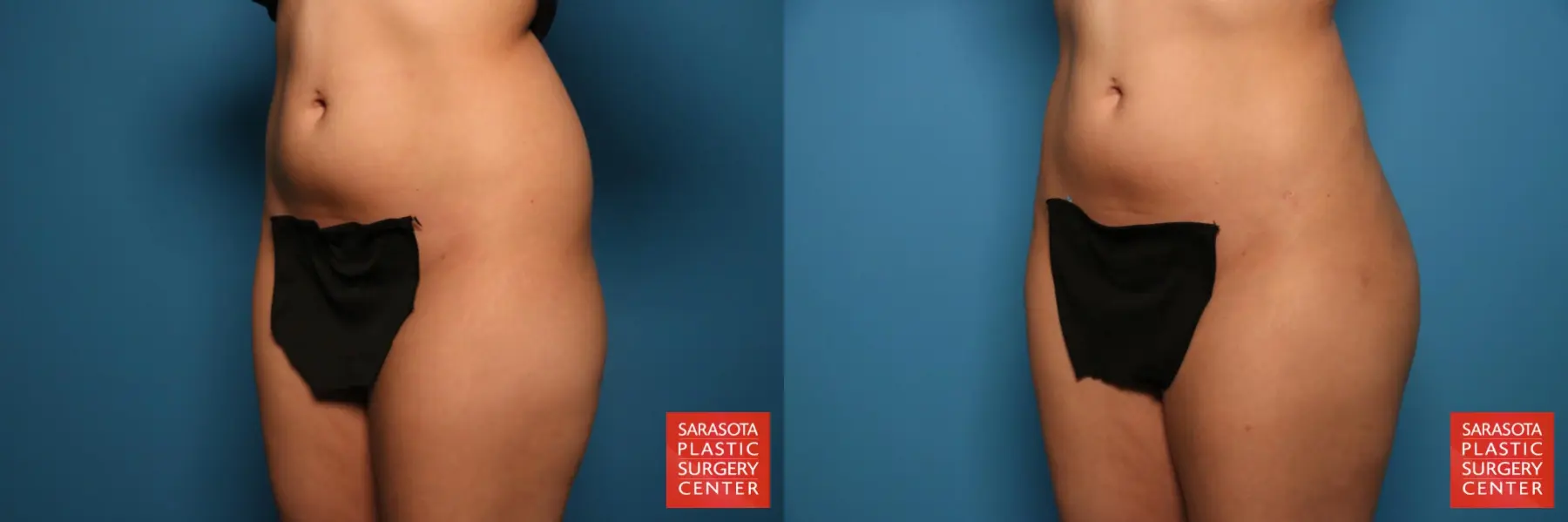 Liposuction: Patient 15 - Before and After 2