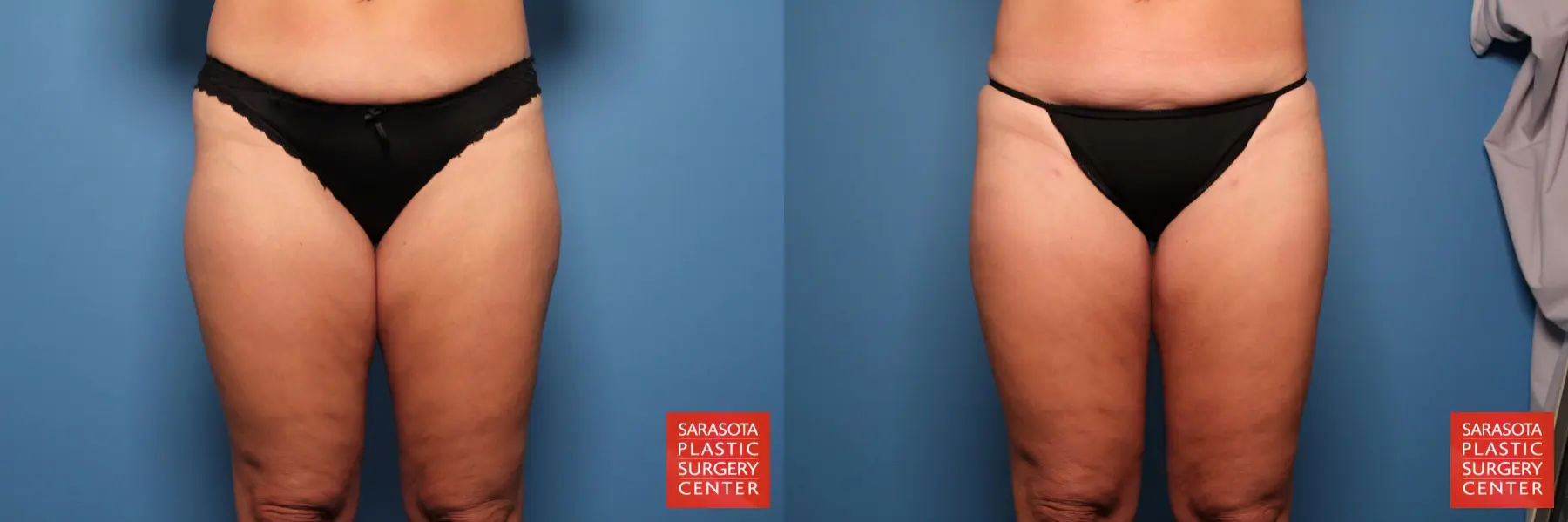 Liposuction: Patient 17 - Before and After  