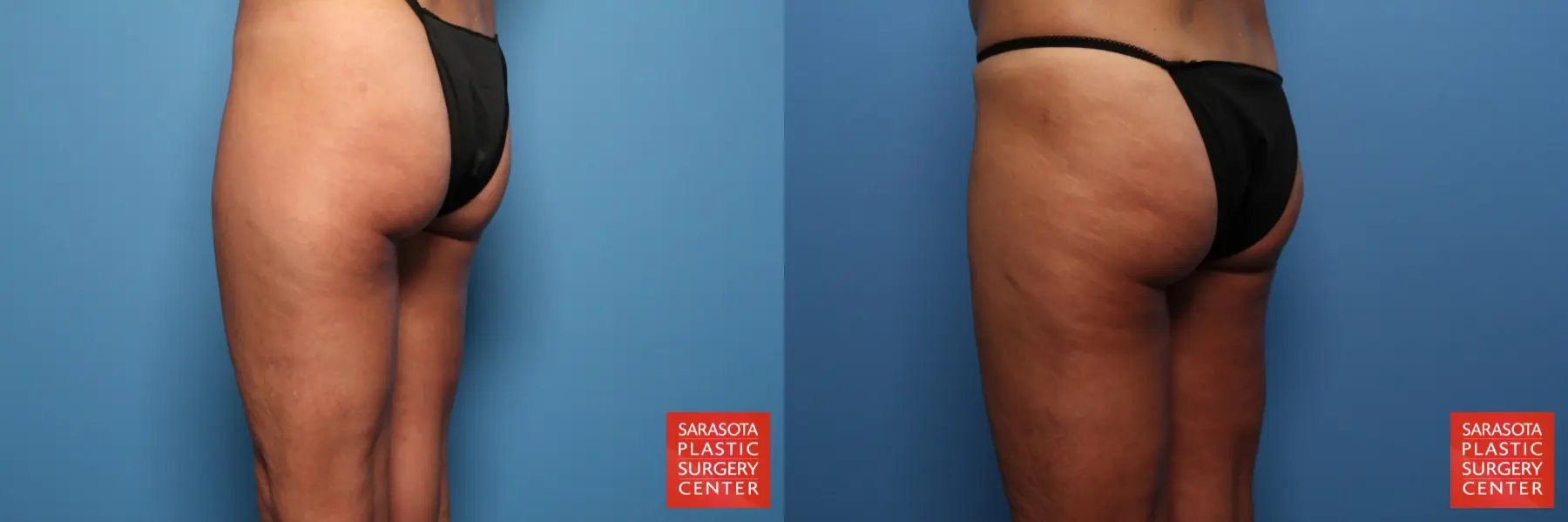Liposuction: Patient 9 - Before and After 4
