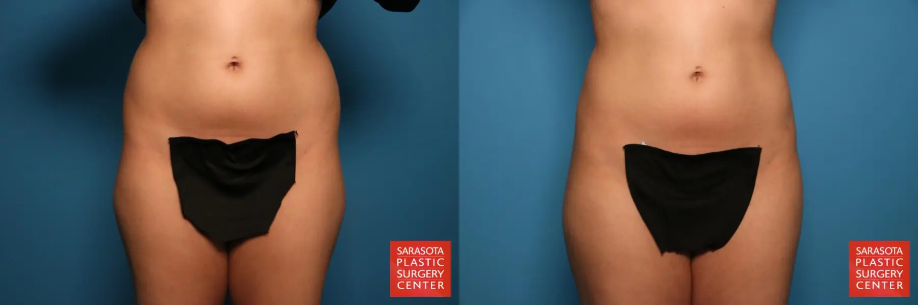 Liposuction: Patient 15 - Before and After  