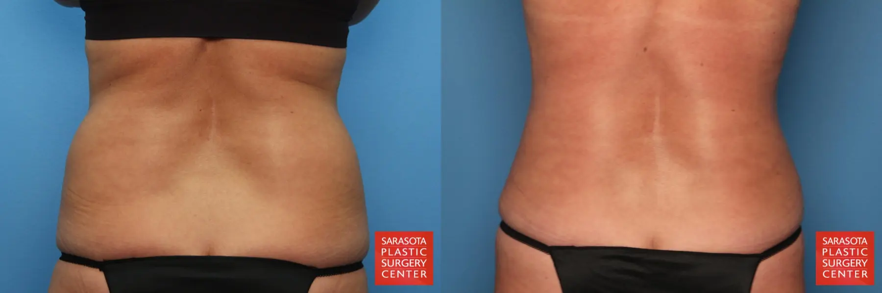 Liposuction: Patient 12 - Before and After 3