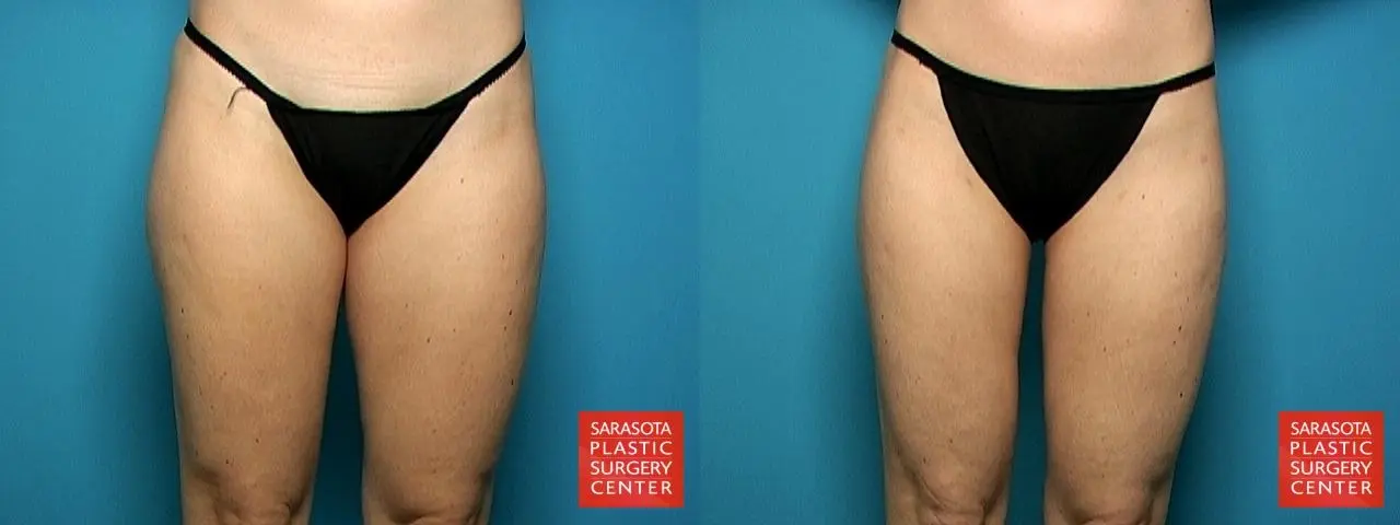 Liposuction: Patient 1 - Before and After  