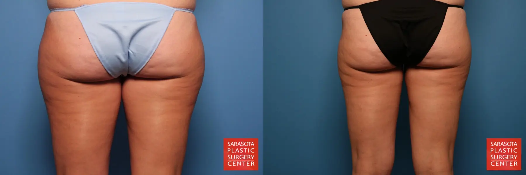 Liposuction: Patient 4 - Before and After 5