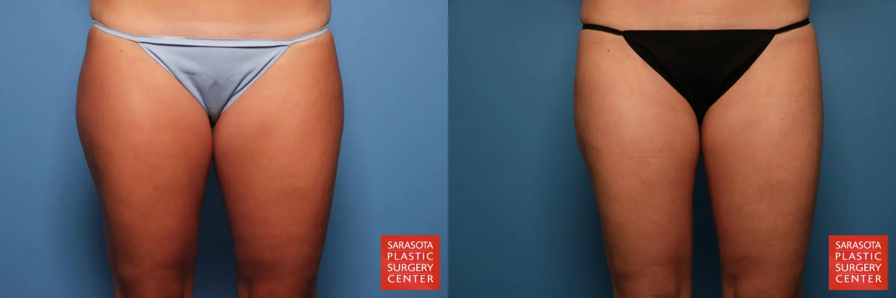 Liposuction: Patient 4 - Before and After 3