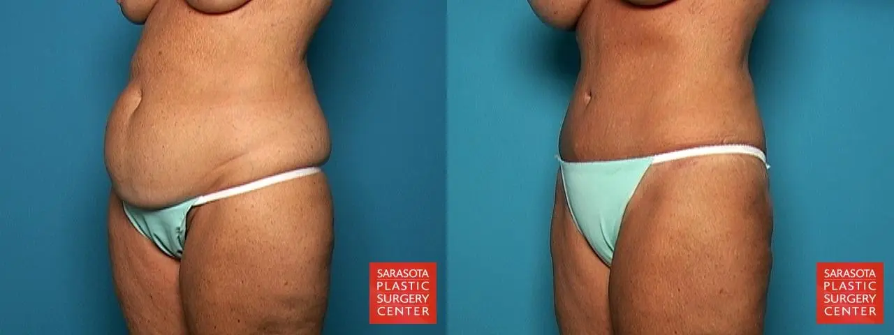 Liposuction: Patient 9 - Before and After 3