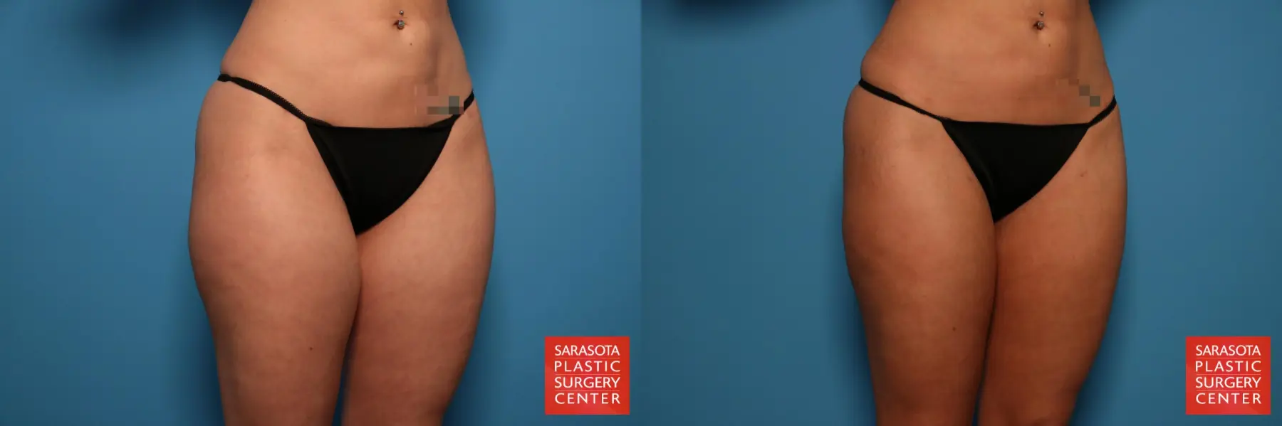Liposuction: Patient 5 - Before and After 3