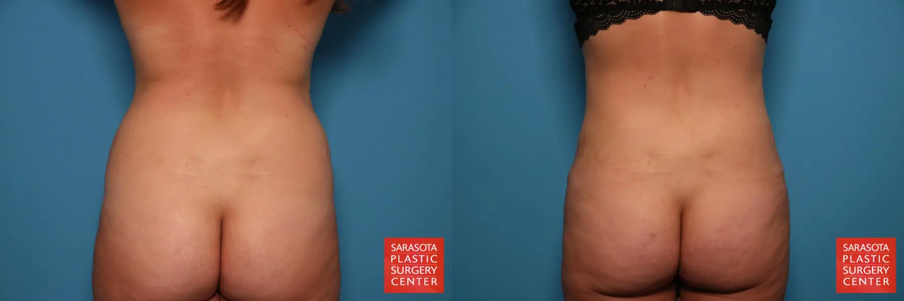 Liposuction: Patient 23 - Before and After  