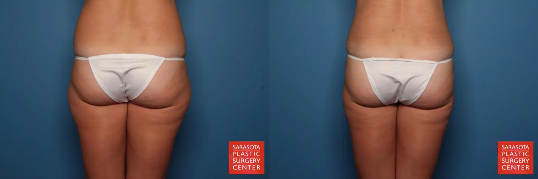 Liposuction: Patient 2 - Before and After 4