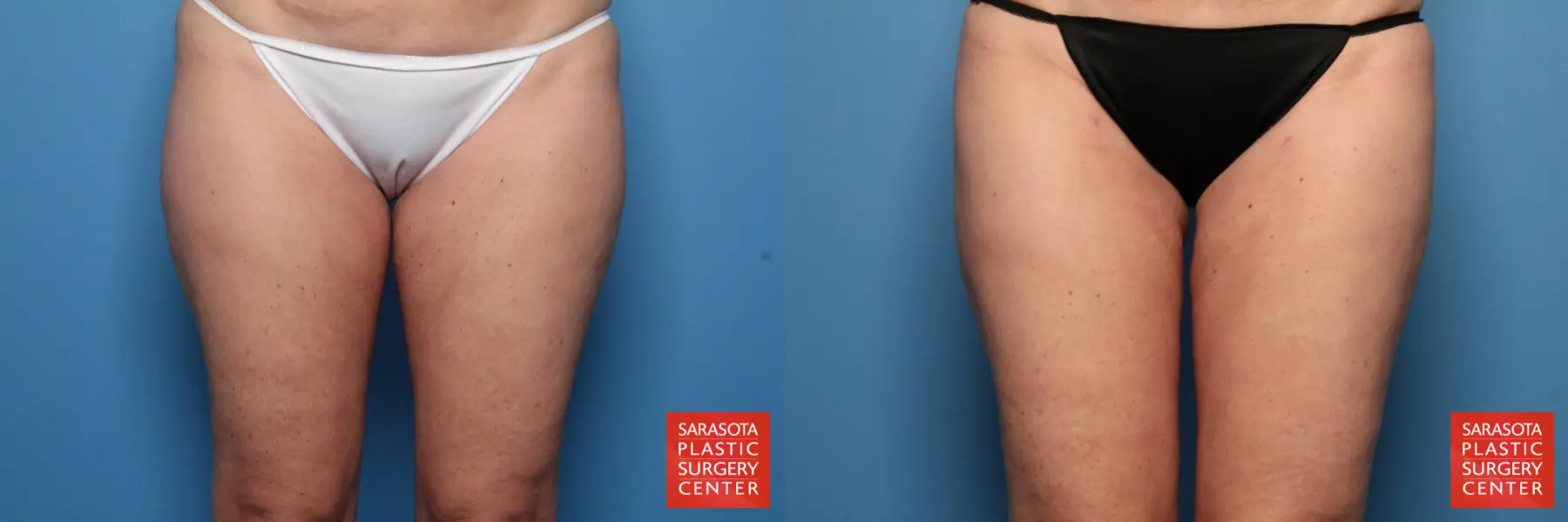 Liposuction: Patient 11 - Before and After 1