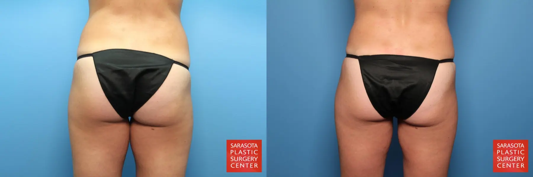 Liposuction: Patient 14 - Before and After 4
