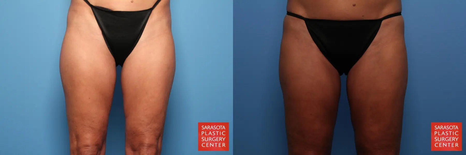 Liposuction: Patient 3 - Before and After  