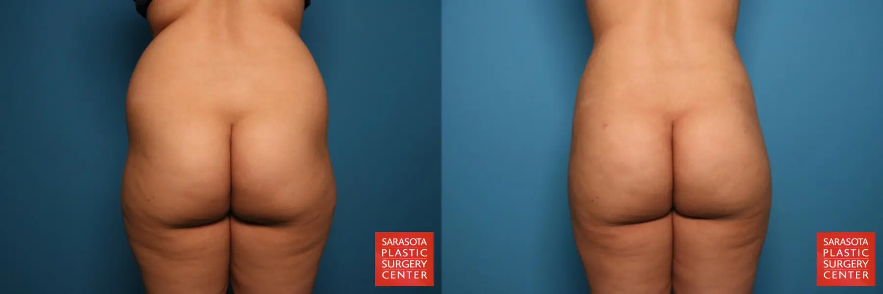 Liposuction: Patient 15 - Before and After 4