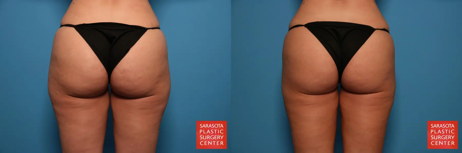 Liposuction: Patient 5 - Before and After 6