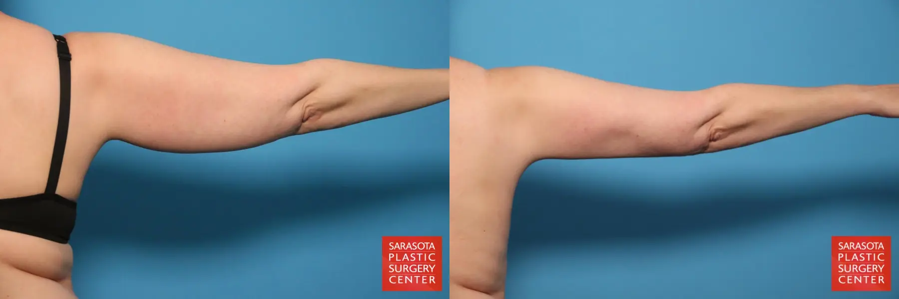 Liposuction: Patient 16 - Before and After 5