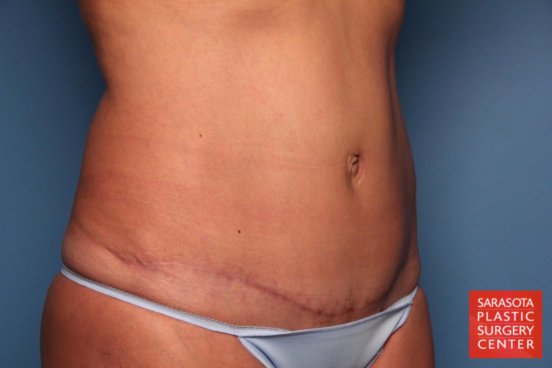 Tummy Tuck: Patient 12 - After 8