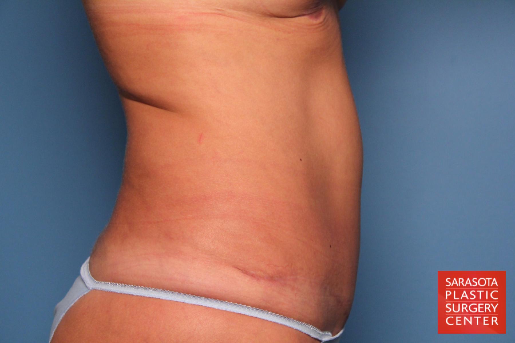 Tummy Tuck: Patient 12 - After 7