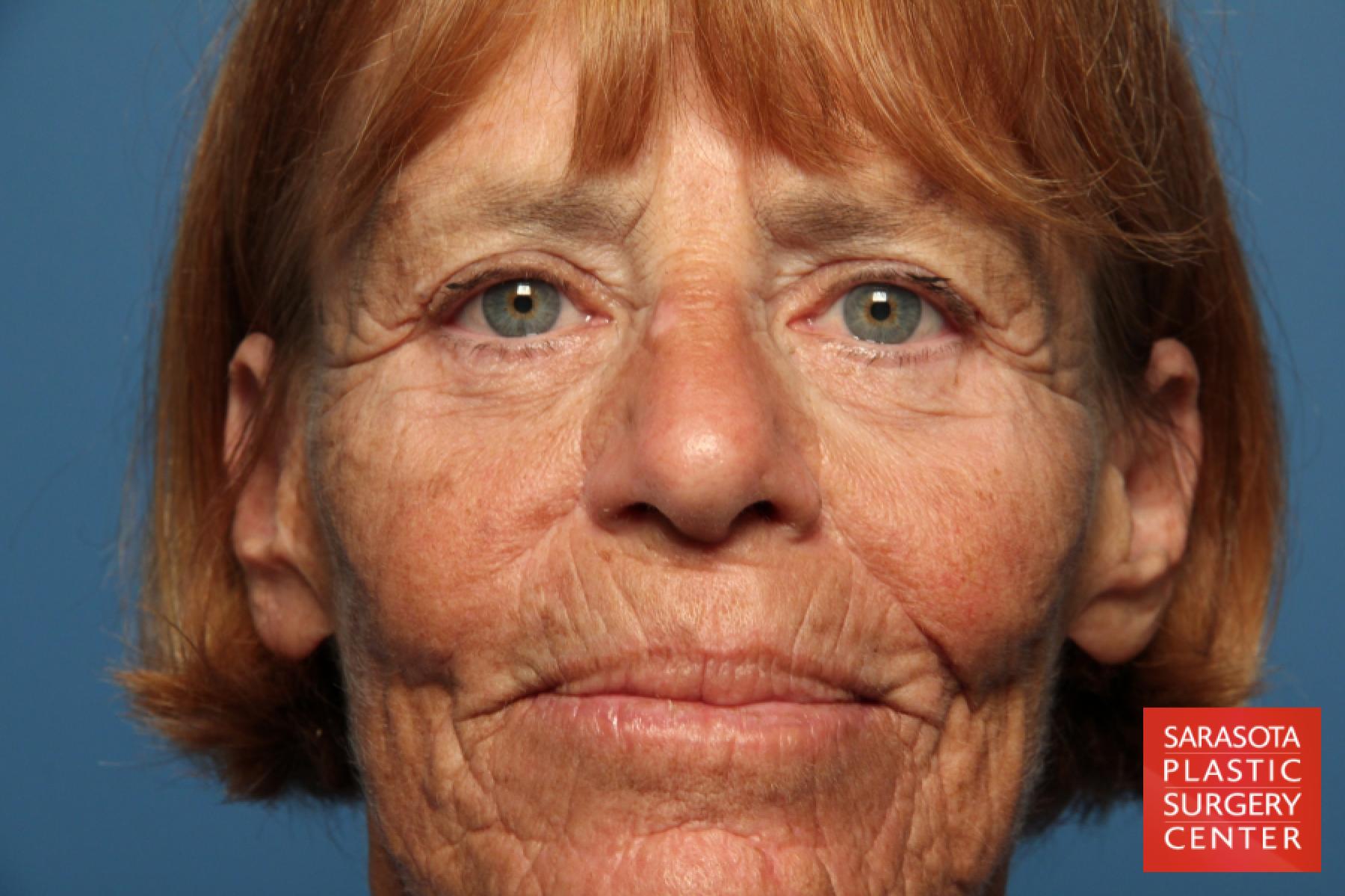 Laser Skin Resurfacing - Face: Patient 16 - Before 1