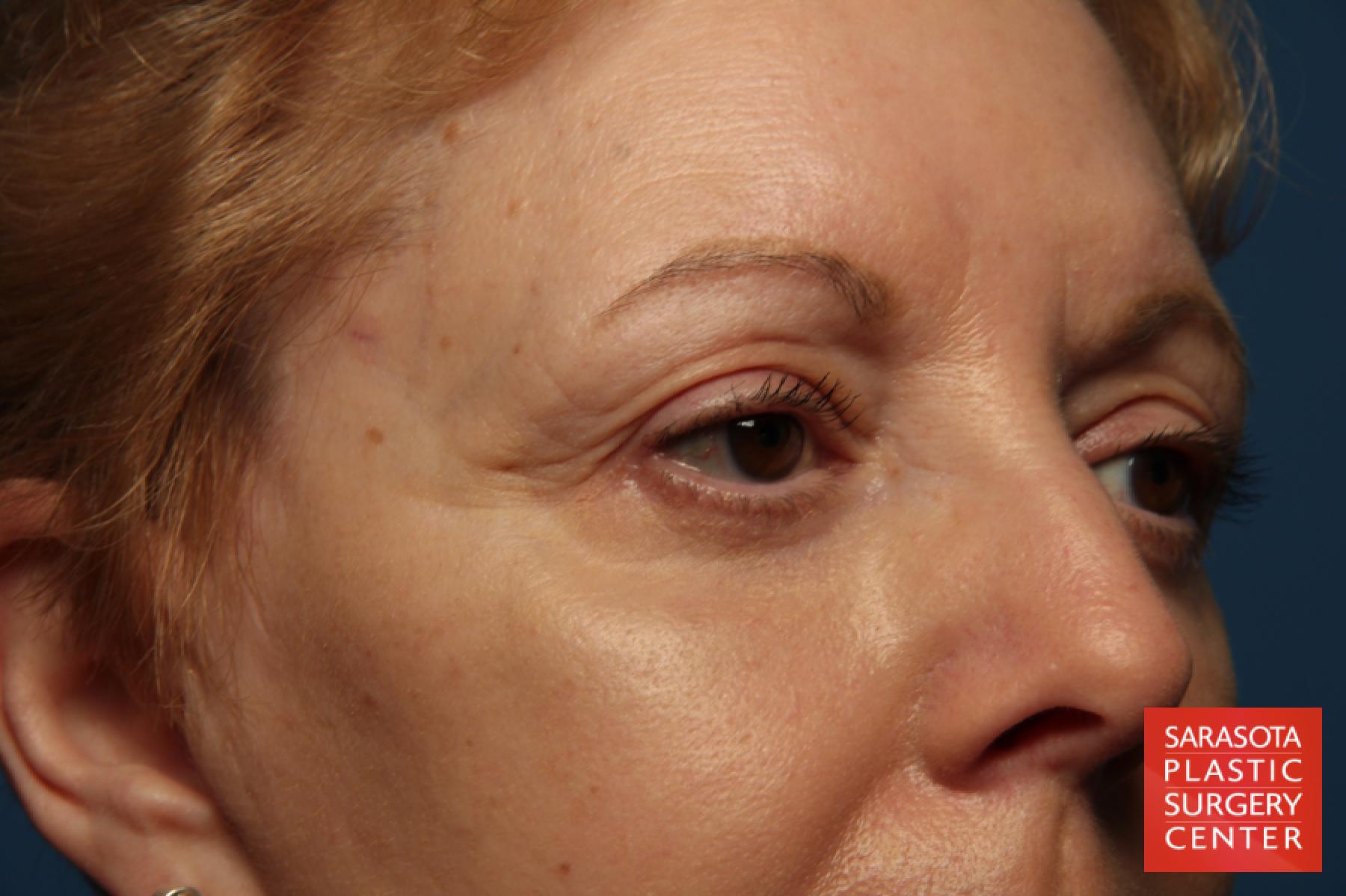 Eyelid Lift: Patient 41 - After 5