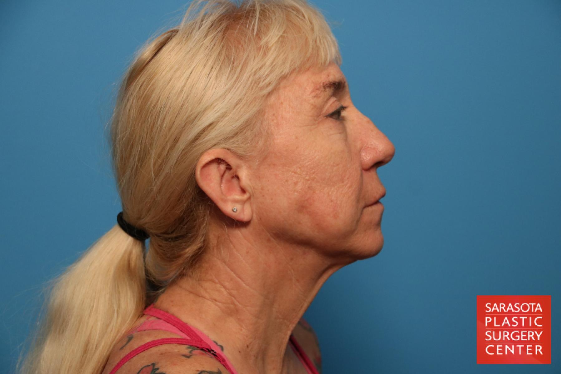 Facelift: Patient 48 - Before and After 5