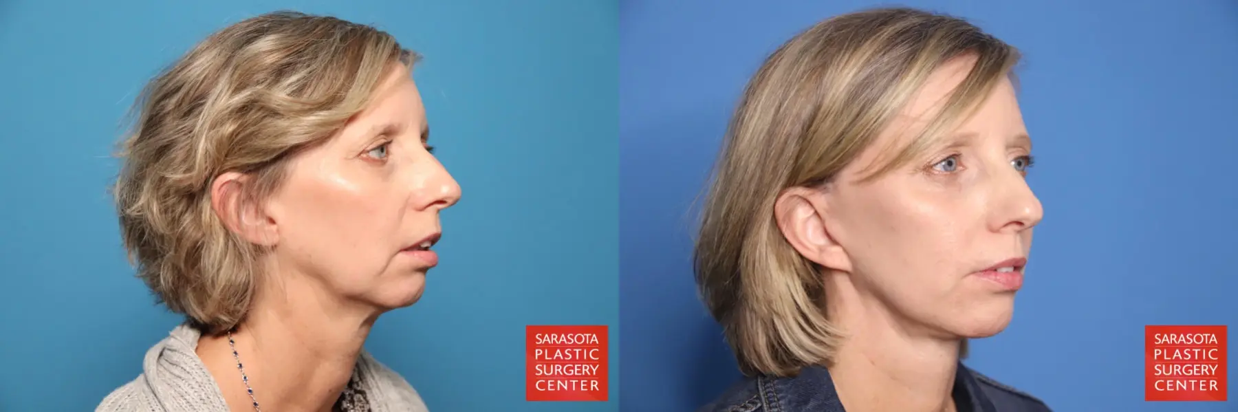 Mini Facelift: Patient 9 - Before and After 2