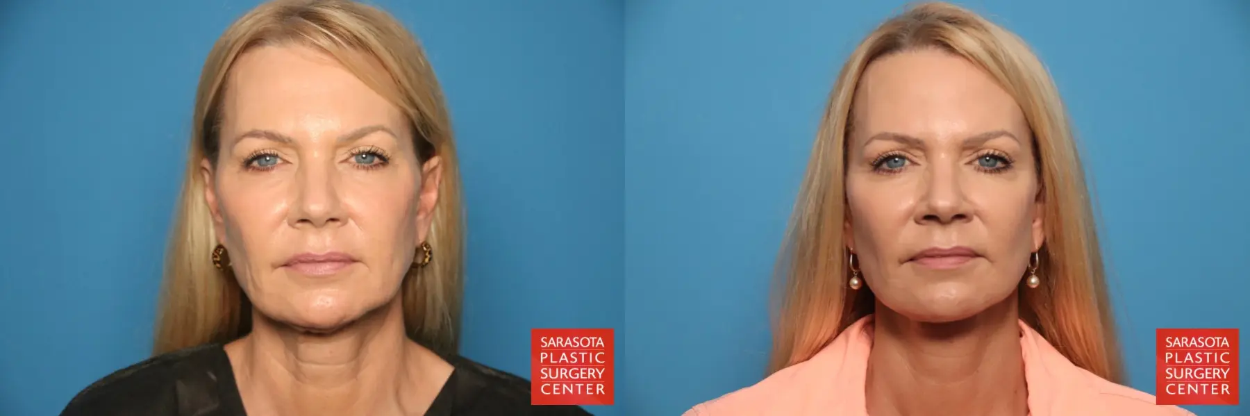 Mini Facelift: Patient 9 - Before and After  