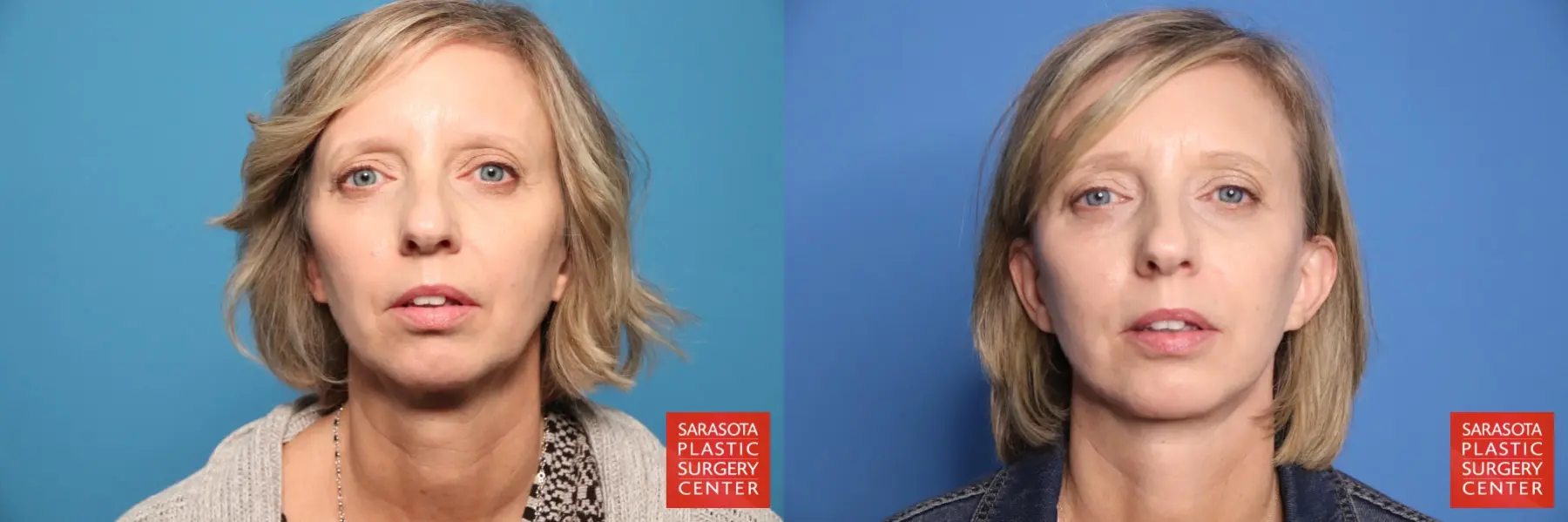 Mini Facelift: Patient 9 - Before and After 1