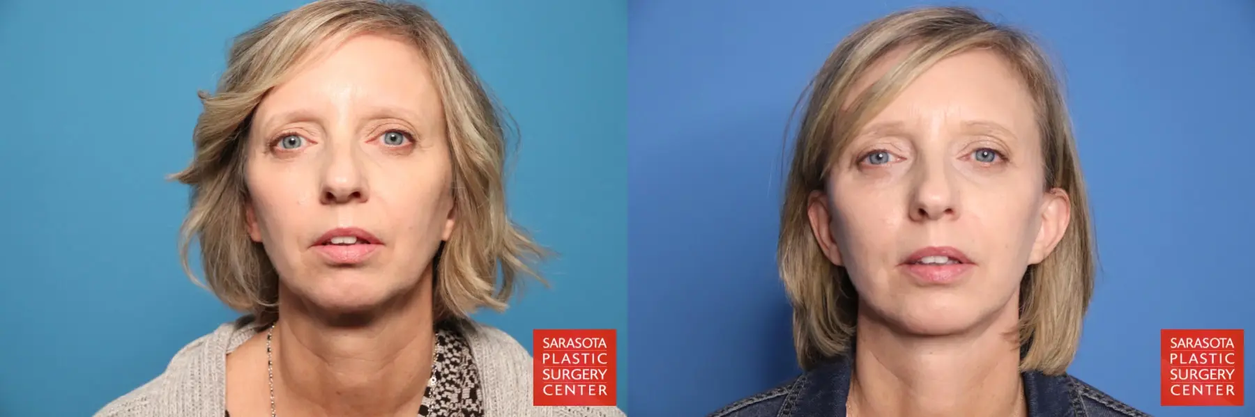 Mini Facelift: Patient 8 - Before and After  