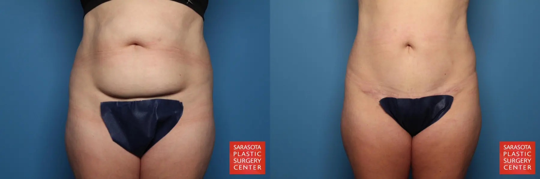 Mini Tummy Tuck: Patient 3 - Before and After  