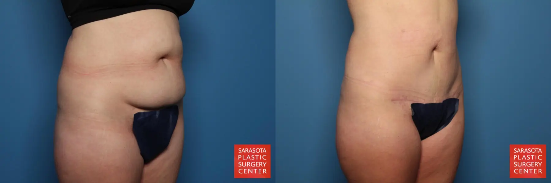 Mini Tummy Tuck: Patient 3 - Before and After 2
