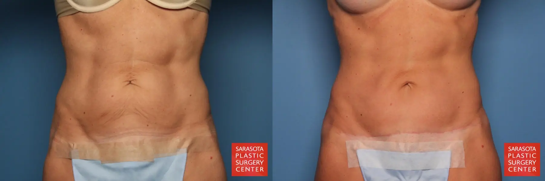 Mini Tummy Tuck: Patient 2 - Before and After 1