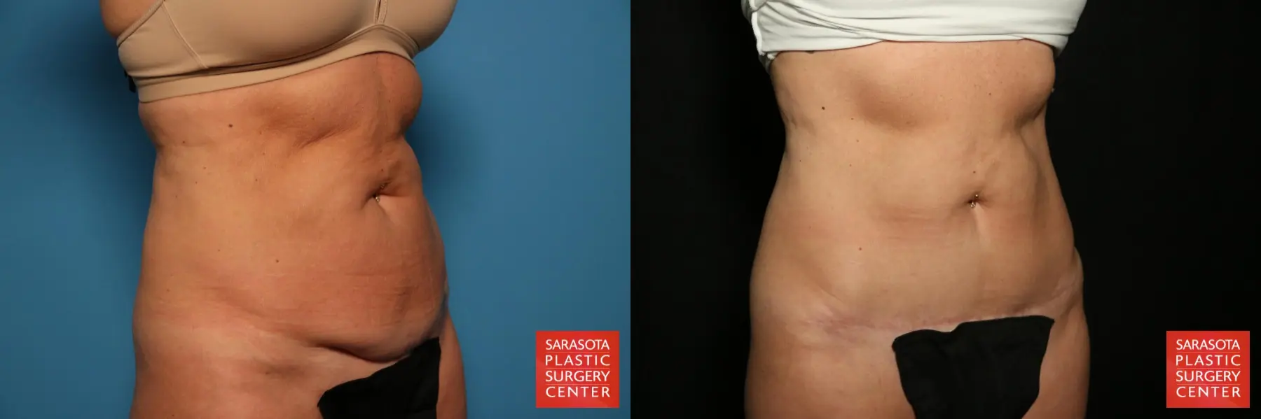 Mini Tummy Tuck: Patient 1 - Before and After 2