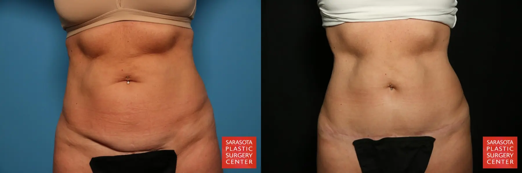 Mini Tummy Tuck: Patient 1 - Before and After  