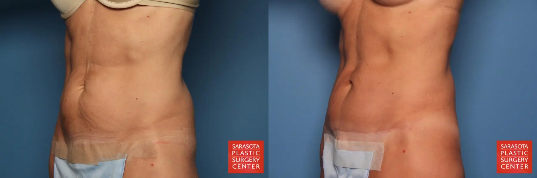 Mini Tummy Tuck: Patient 2 - Before and After 2