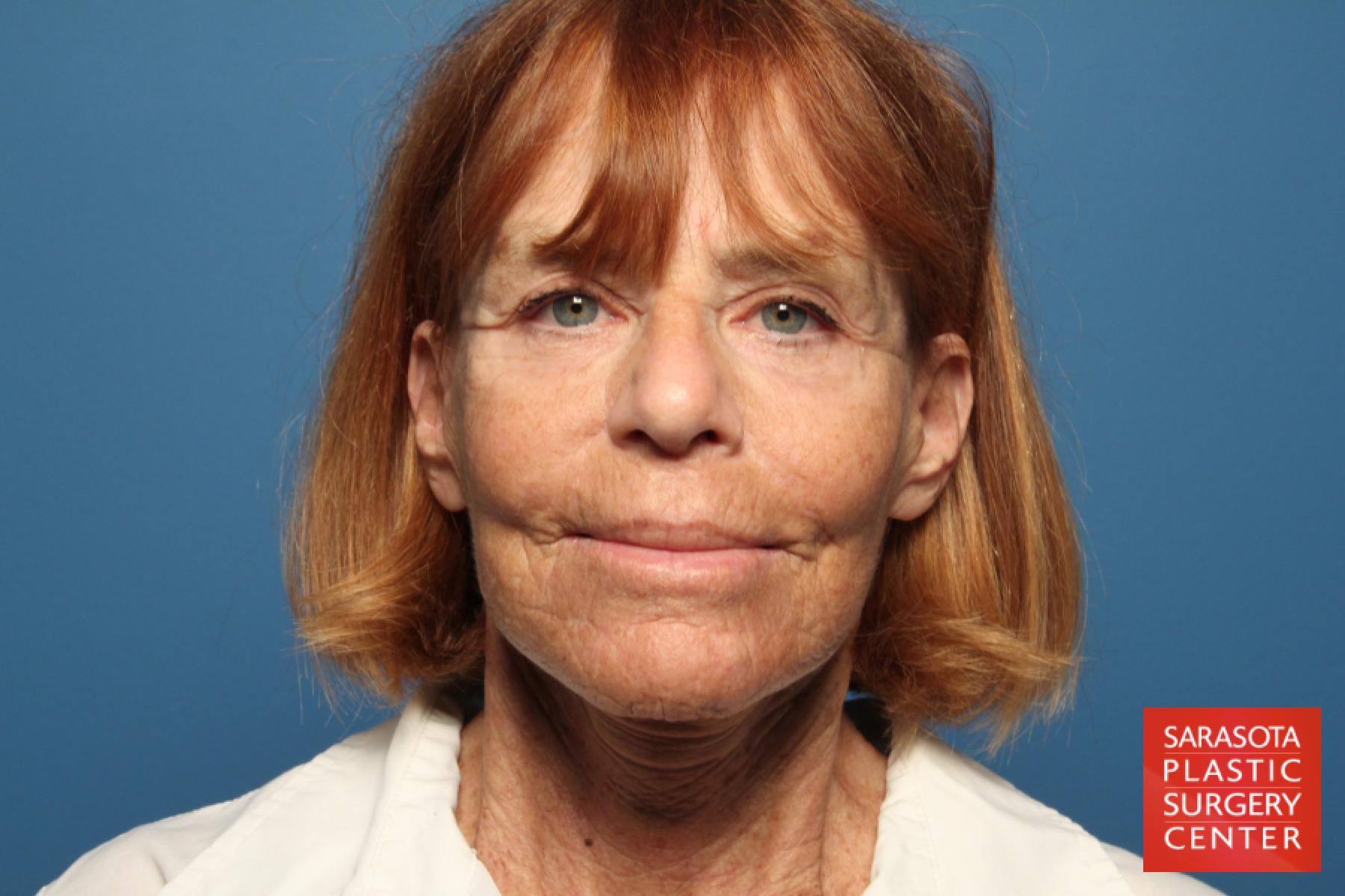 Laser Skin Resurfacing - Face: Patient 16 - After 3